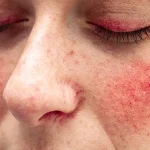 Tuel Rosacea Skin Treatment